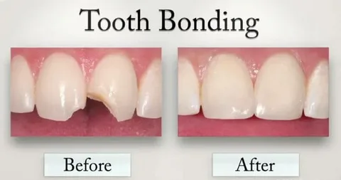 Tooth bonding cost with insurance