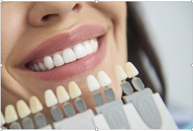 Dental insurance for veneers