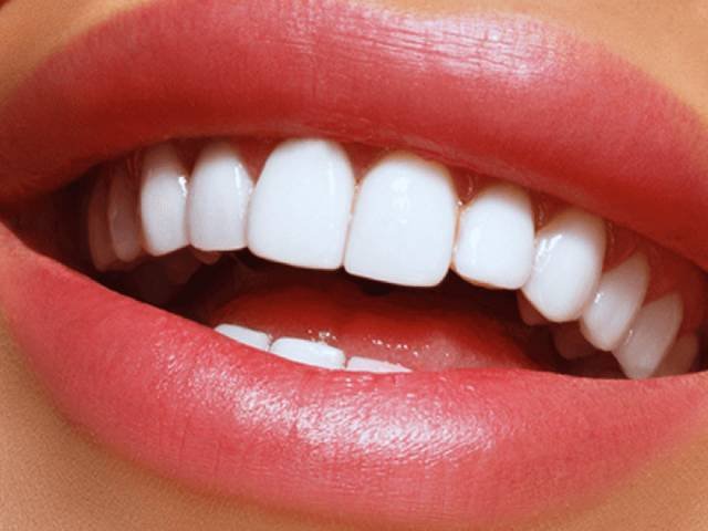 Dental insurance for veneers