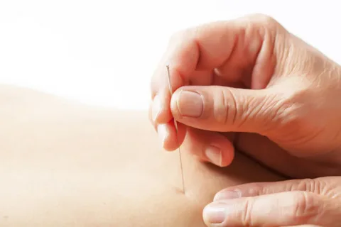 Is dry needling covered by insurance